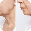 Comparison Image for injectables - 3