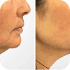 Comparison Image for injectables - 4