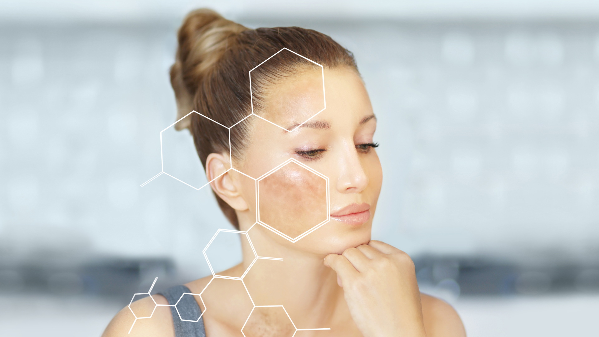 Hyperpigmentation