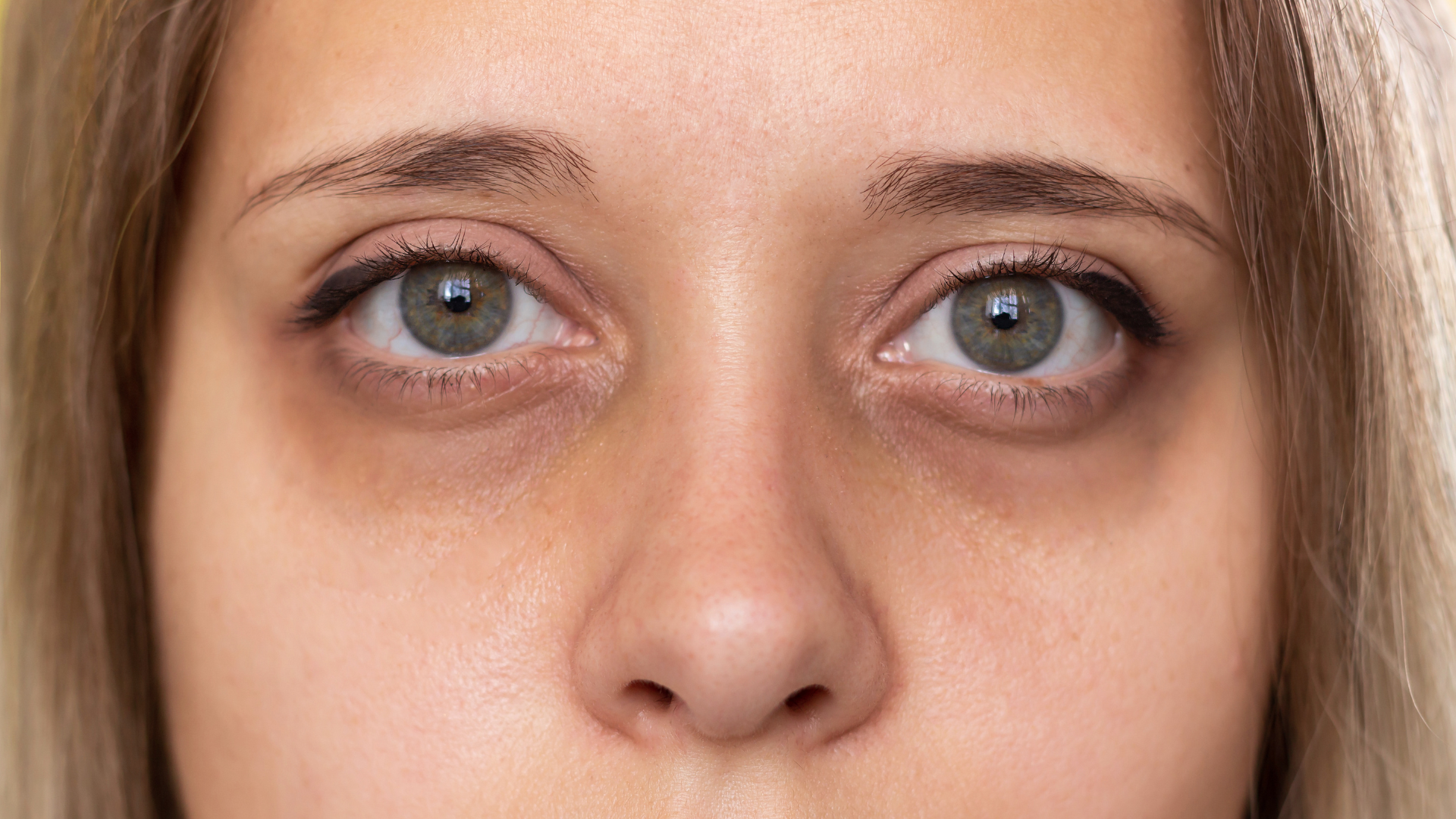 Dermal Fillers