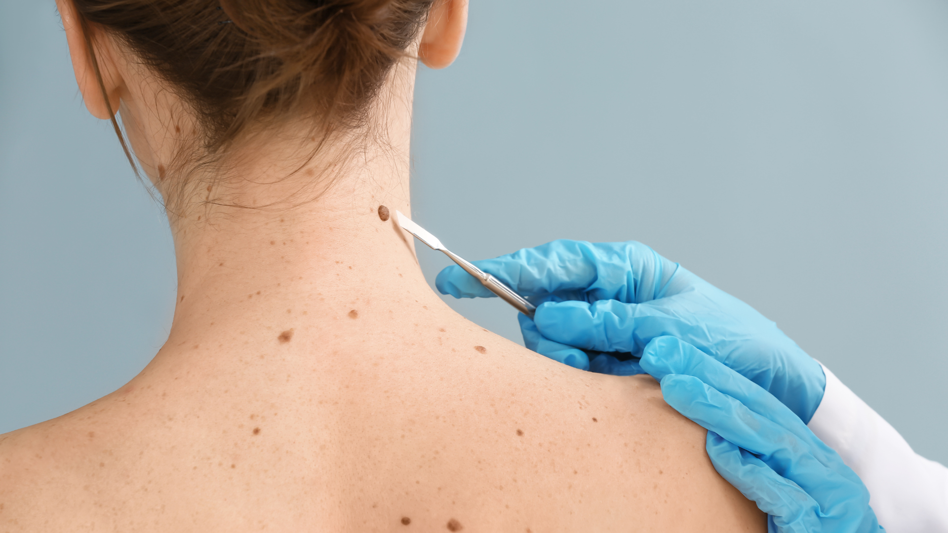 Freckle Removal